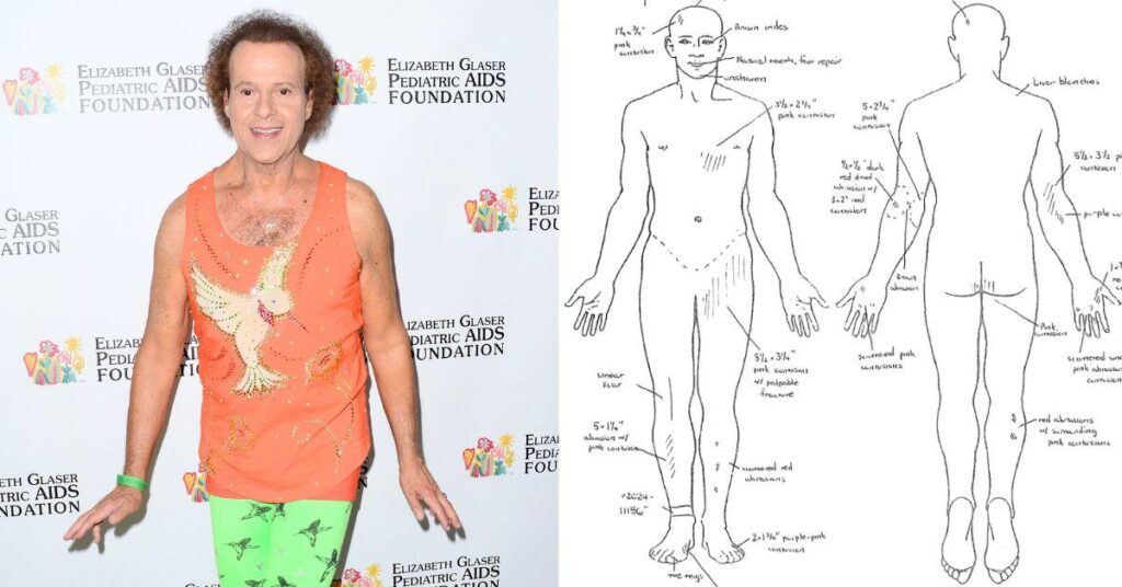 Richard Simmons' Autopsy Reveals 76-Year-Old Was Riddled With Cuts, Bruises