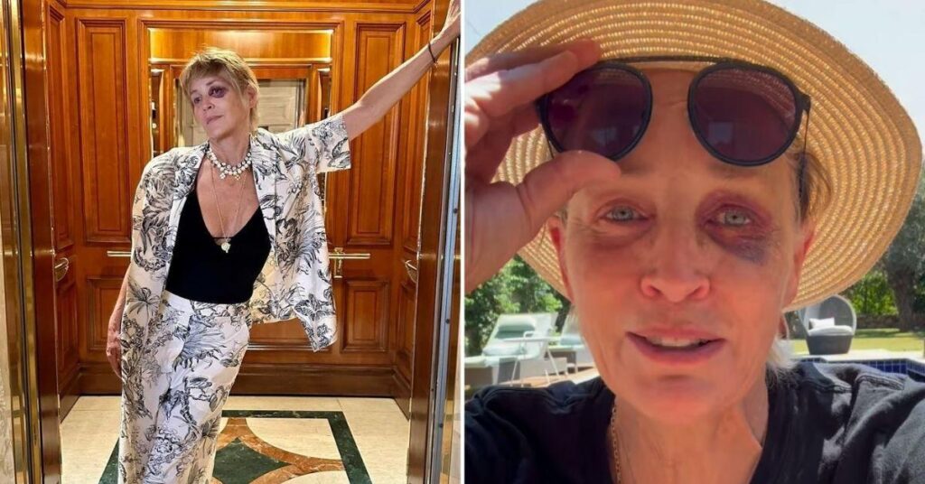 Sharon Stone Reveals Cause of Black Eye Was ‘Smacking Face on Marble’