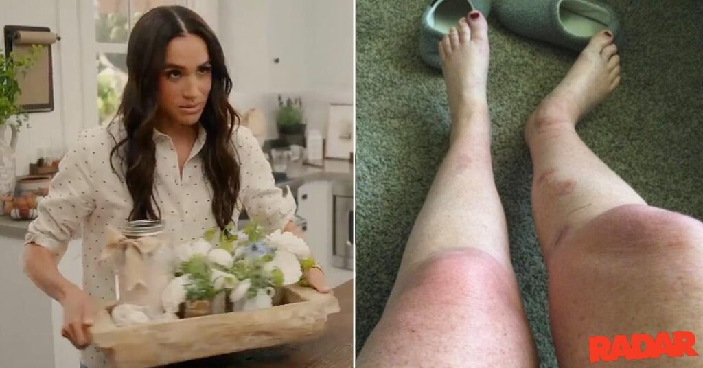 Meghan Markle Fan To Sue Duchess After Suffering 'Catastrophic’ Burns'