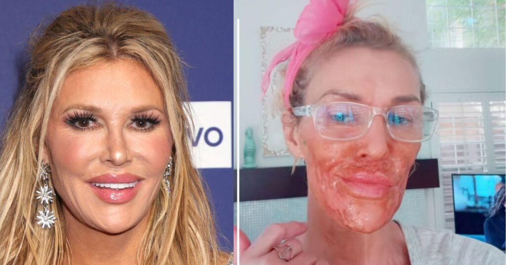 Burns Face With Hair Removal Cream