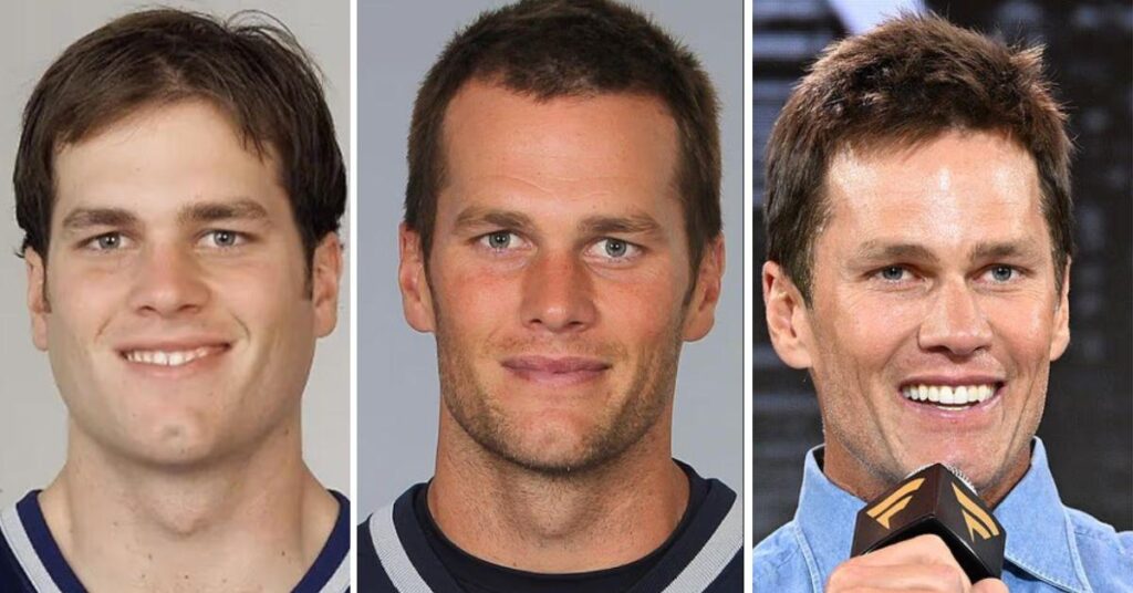 Tom Brady's Secret Nip Tuck to Remove Skin Around the Eyes