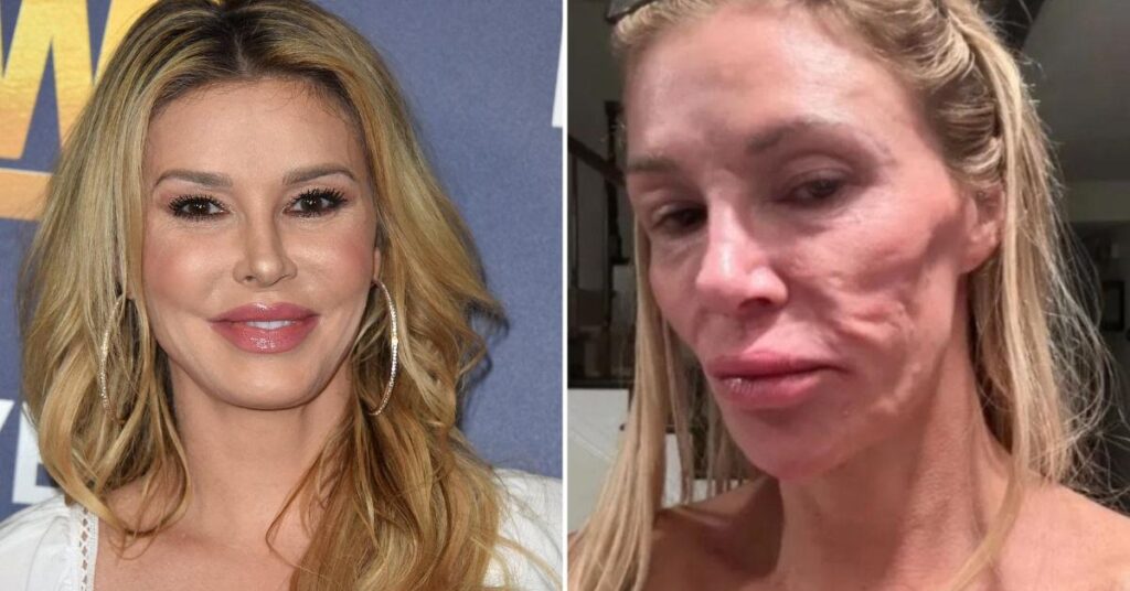 Inside Brandi Glanville’s Facial Parasite Terror That Left Doctors Baffled Inside Brandi Glanville's Facial Parasite Terror That Left Doctors Baffled