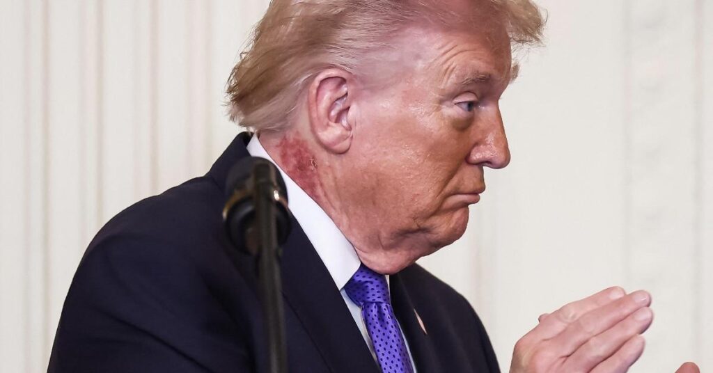 Trump's Neck Rash Labeled 'Precancerous Skin Condition' By Famed Doc